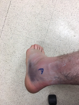 Illustration for article titled Dude, Jason Kipnis, Are You Sure You Can Play On Your Sprained Ankle?